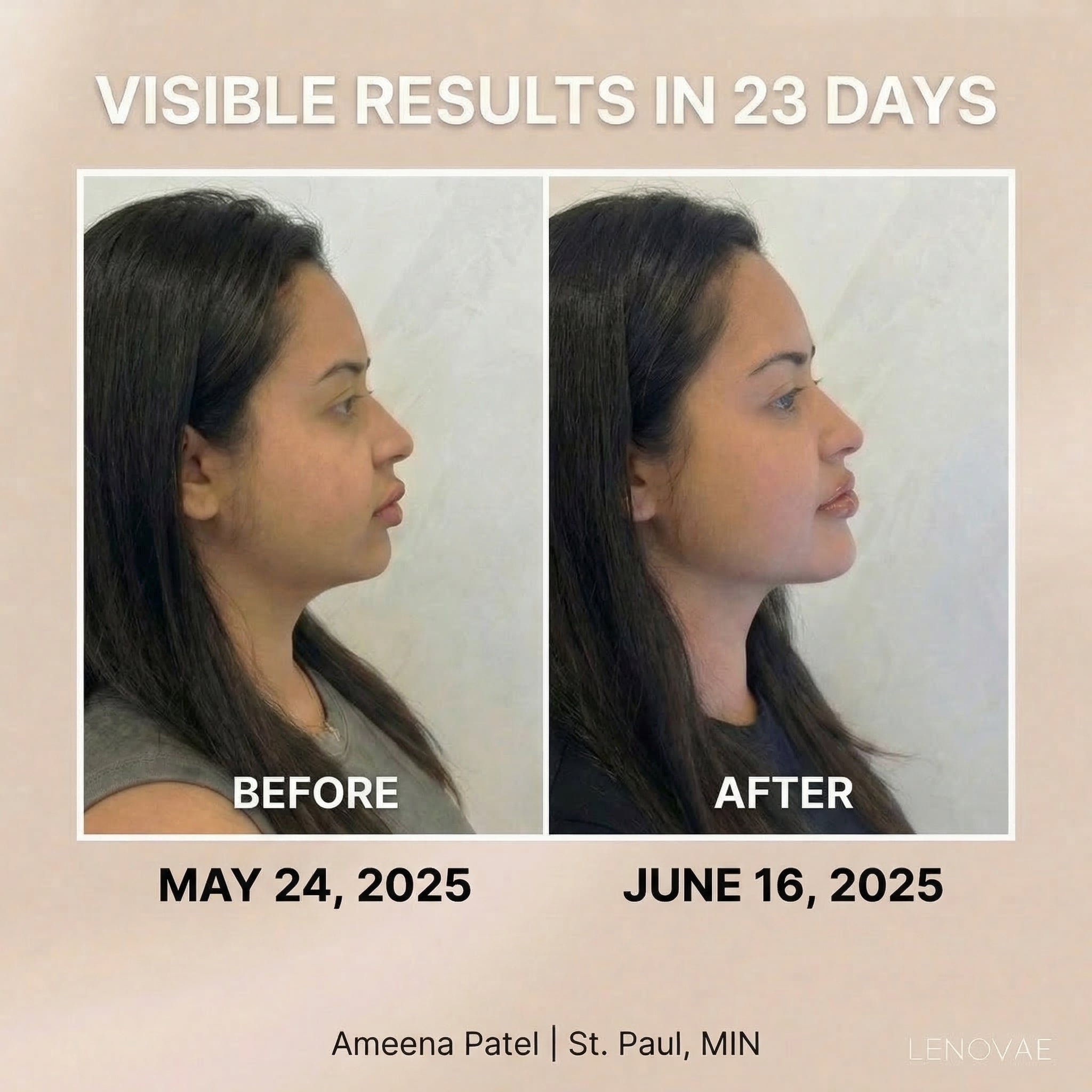 LENOVAE™️ VIRAL 4-IN-1 FACE SCULPTOR